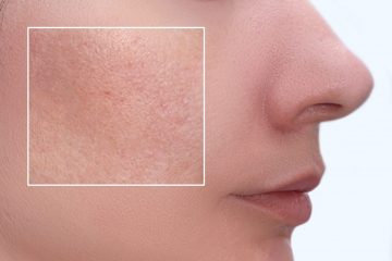 Face of a young woman with an accent on a skin enlarged pores and imperfections treatment, beauty treatment befire and after Face of a young woman with an accent on a skin enlarged pores and imperfections treatment, beauty treatment befire and after.