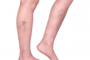 Varicose veins in the legs. Woman legs isolated on white