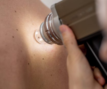 Close-up of a Dermatologist Mole Mapping on Patient's Back.